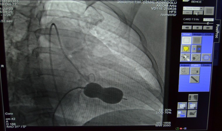 Alanyada mitral kapak darlığı ameliyatsız tedavi edildi