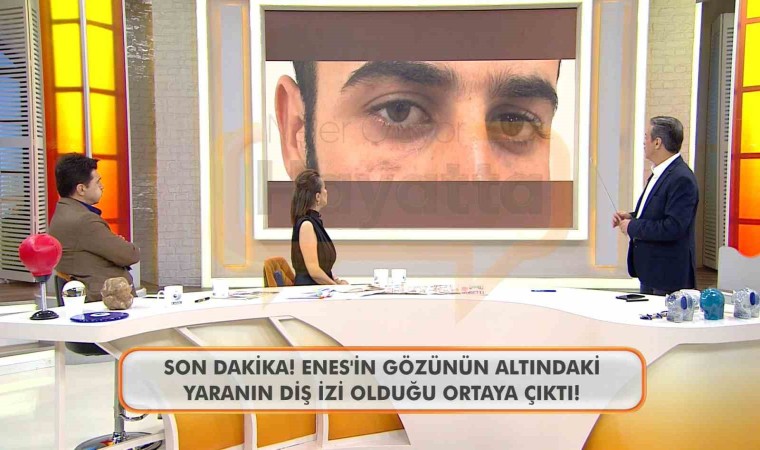 Canlı yayında Enes Güranın gözünün altındaki diş izine dikkat çekildi