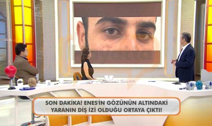 Canlı yayında Enes Güranın gözünün altındaki diş izine dikkat çekildi